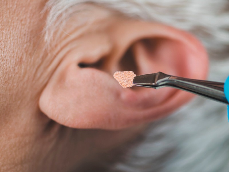 Auriculoterapia  